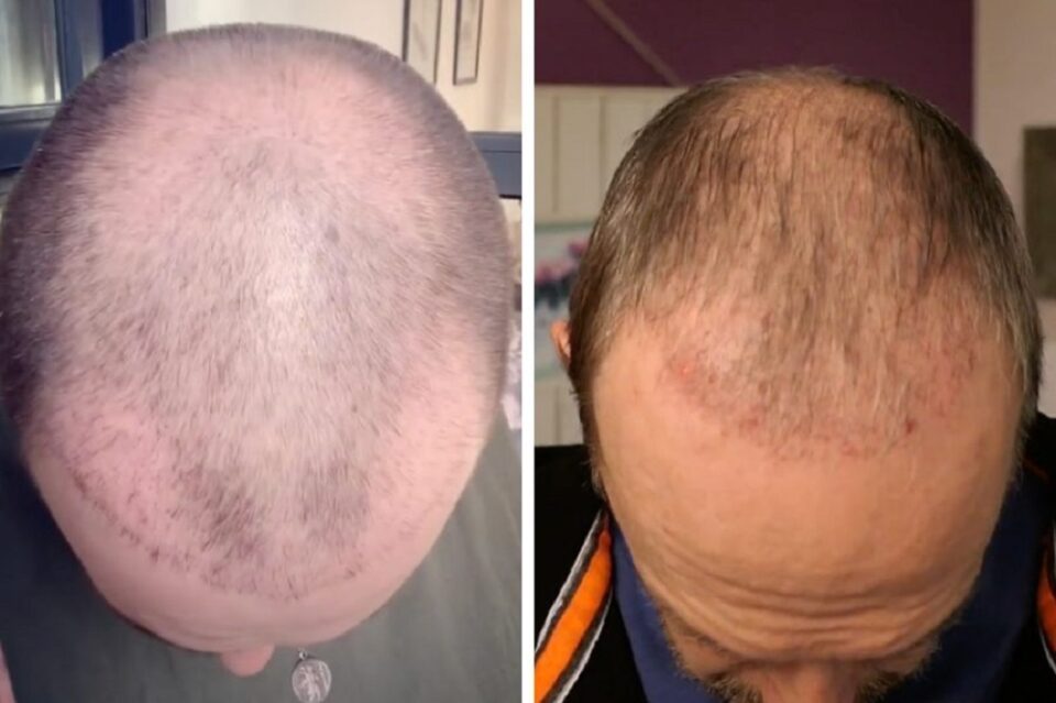 hair transplant in Melbourne